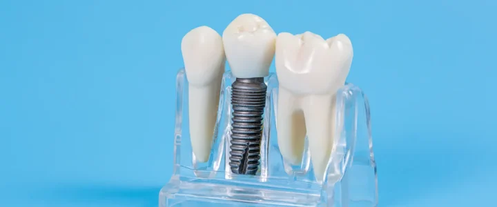 Najlepszy licówki porcelanowe Szczecin