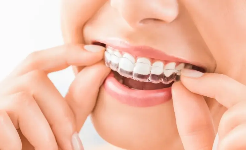 Aparat Invisalign